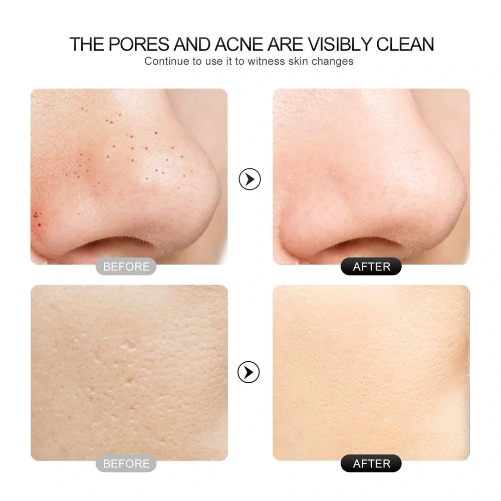 Pore Extractor Face Spatula Deep Cleansing for Facial Skincare